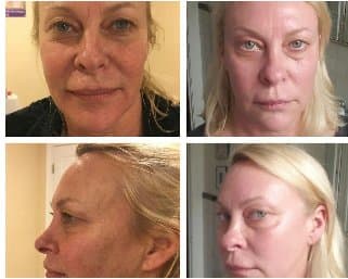 Erbium YAG Resurfacing before and after results