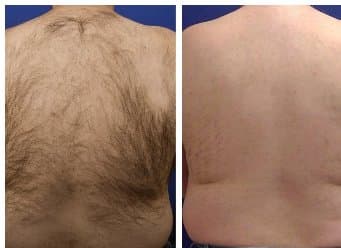 Laser Hair Removal before and after results