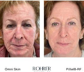 RF Microneedling before and after results