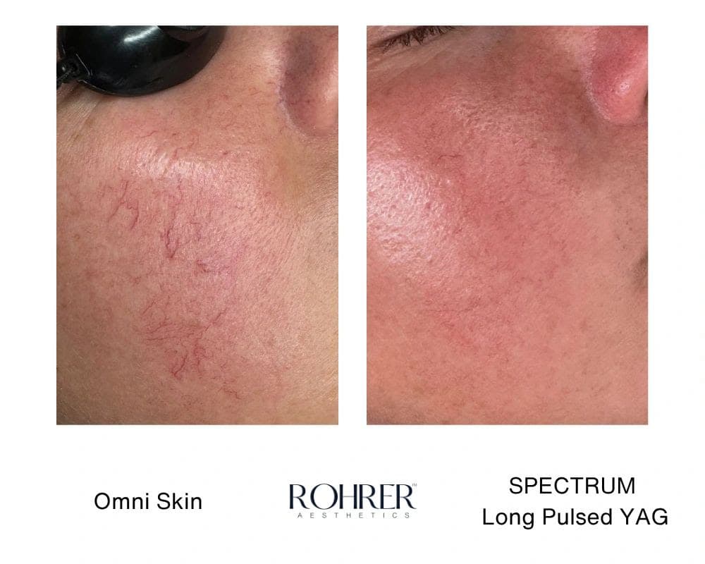 Spider Vein Removal before and after results