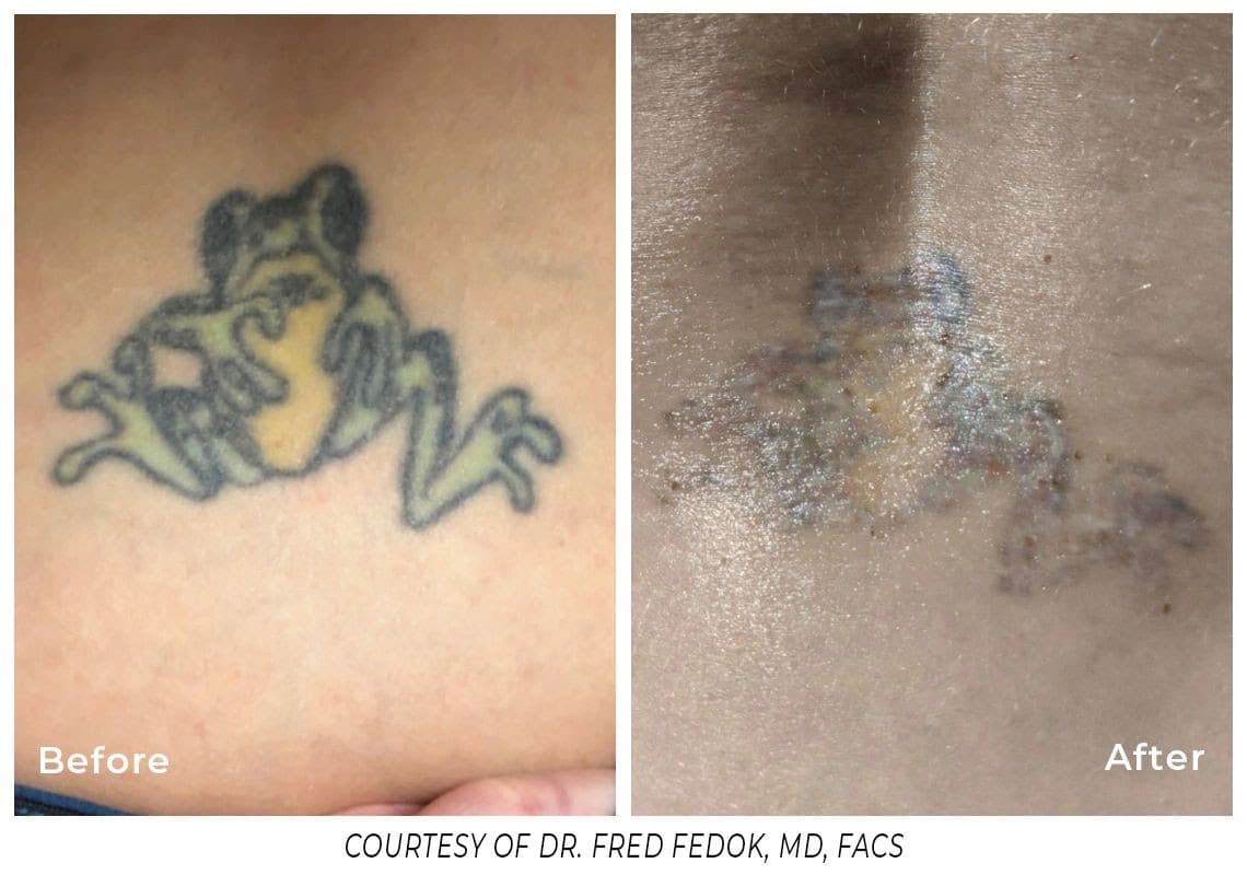 Tattoo Removal before and after results